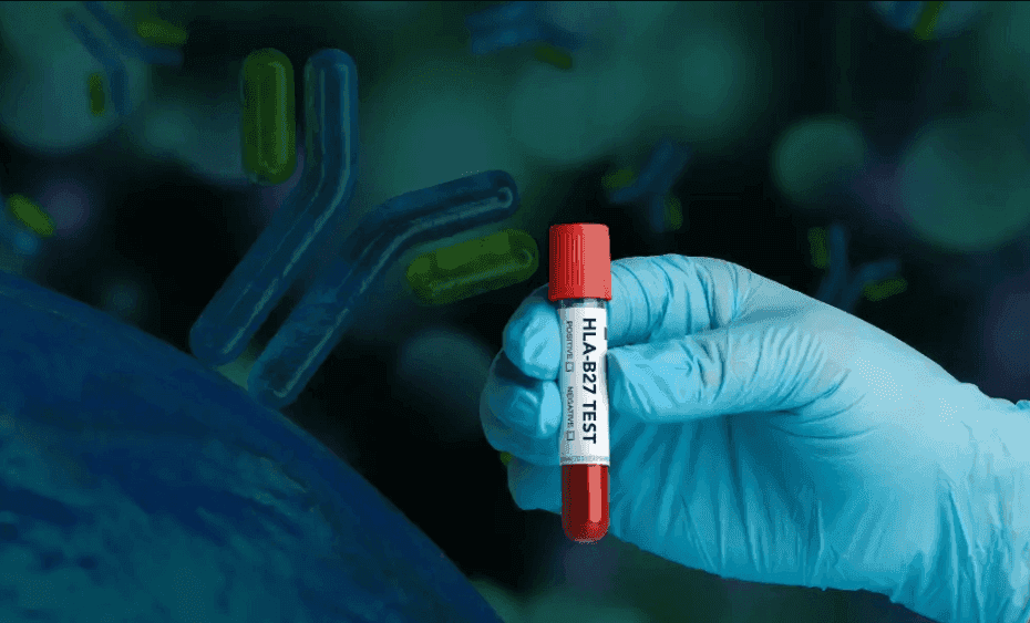 HLA B27 Test